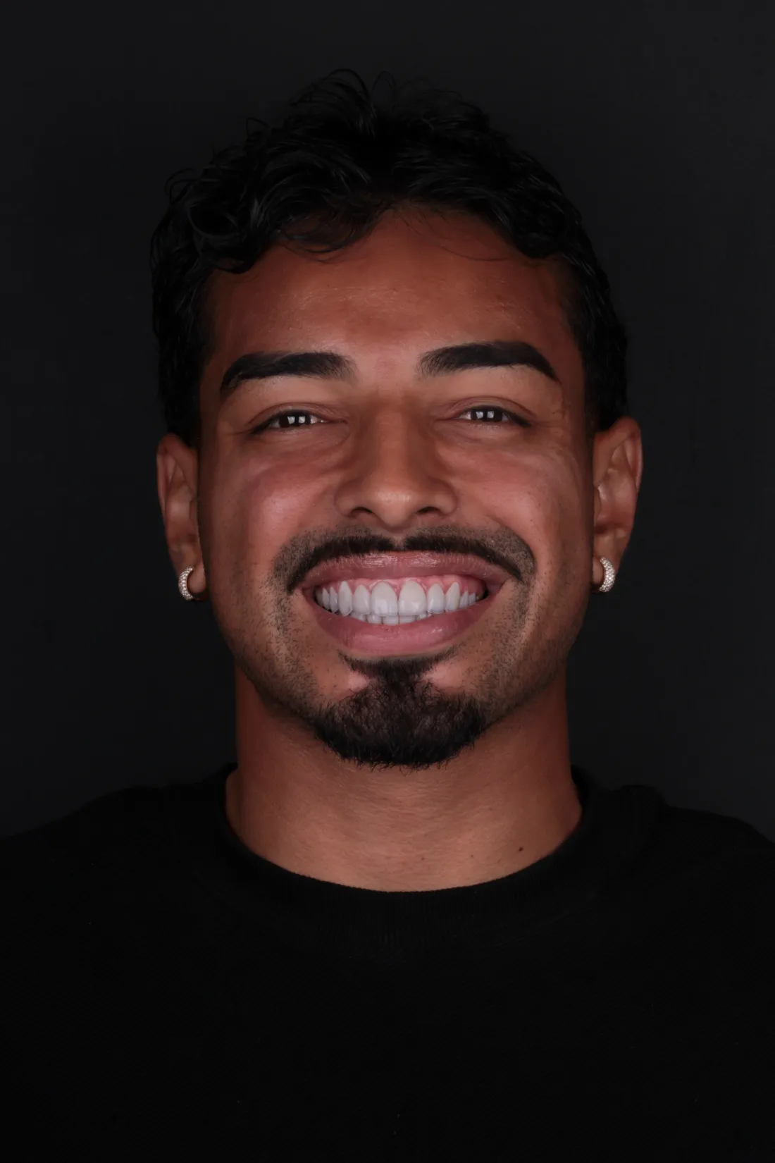 Lentes de porcelana ou resina: qual é a melhor para o seu sorriso?