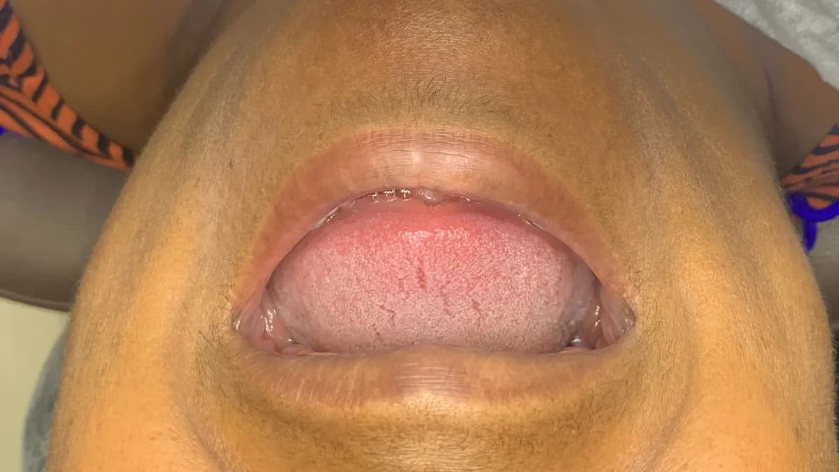 Protocolo de prótese fixa: dentes fixos para quem perdeu todos os dentes